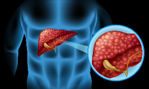 What are the symptoms of Fatty Liver? Best Gastroenterologist in Kerala