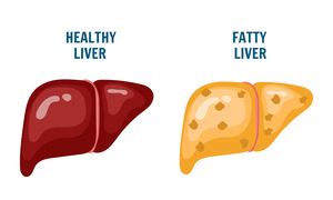 fatty-liver